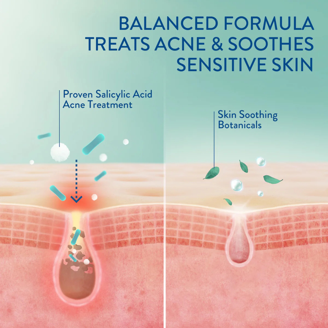 Cetaphil | Gentle Clear | Matte Acne Moisturizer | Salicylic Acid Acne Treatment