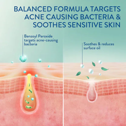 Cetaphil | Gentle Clear Complexion Clearing BPO Acne Cleanser