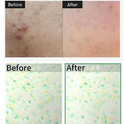 CICA X Hyalon | Reedle Shot 100