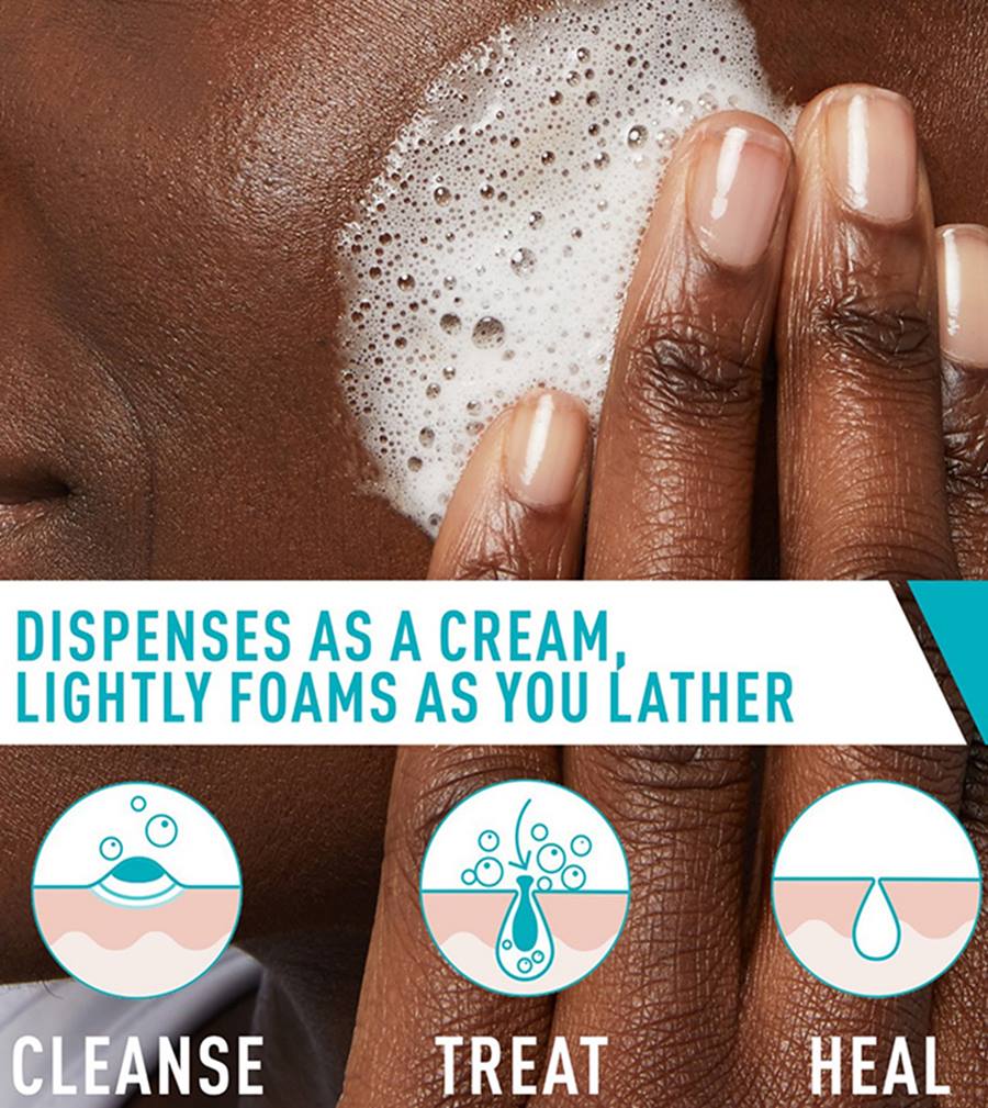 CeraVe Acne Foaming Cream Cleanser – 4% Benzoyl Peroxide
