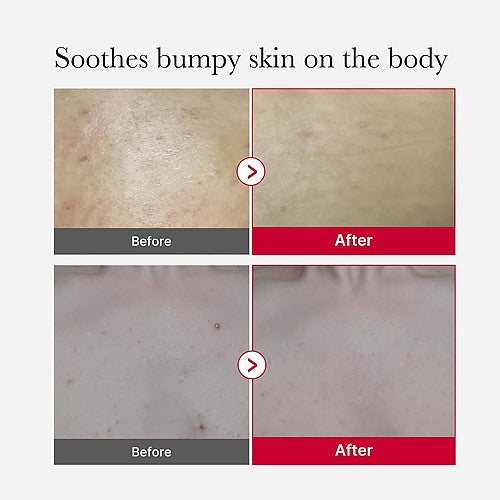 Medicube Red Acne Body Peeling Shot