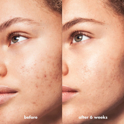 e.l.f. SKIN Blemish Breakthrough Triple‑Acid Resurfacing Serum