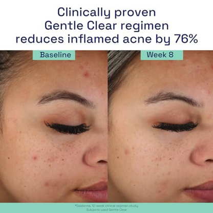 Cetaphil | Gentle Clear | Clarifying Acne Cream Cleanser | Salicylic Acid Acne Treatment