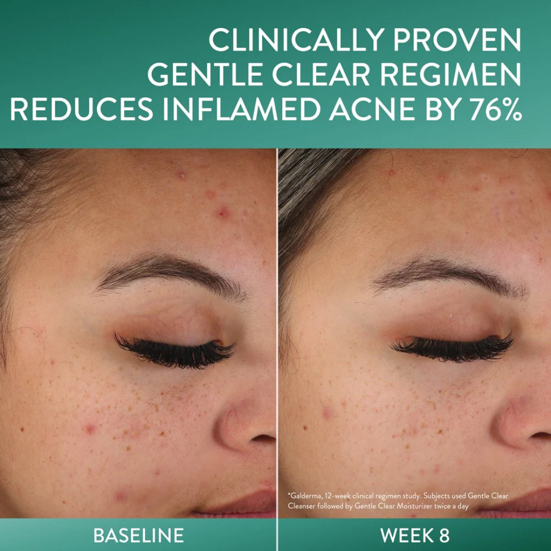 Cetaphil | Gentle Clear | Matte Acne Moisturizer | Salicylic Acid Acne Treatment
