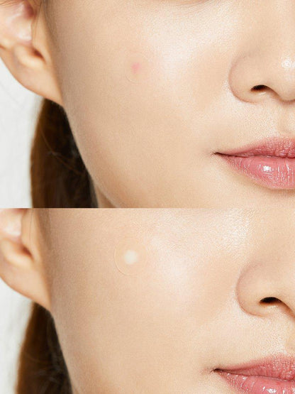 COSRX Acne Pimple Master Patch (24 Patches) – Hydrocolloid Spot Treatment