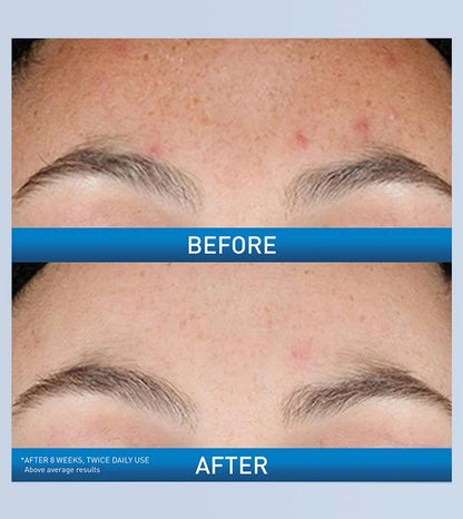 CeraVe Resurfacing Retinol Serum | Post-Acne Marks Treatment